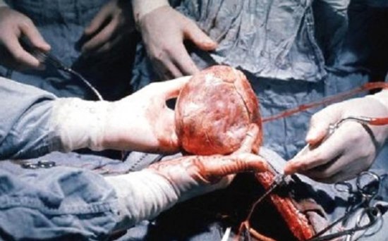 Ürəyindən 4 sm uzunluğunda iynə çıxarıldı