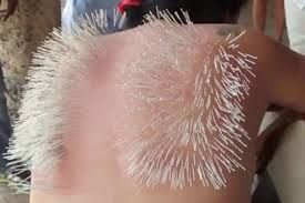 Bədəninə minlərlə iynə batırdı