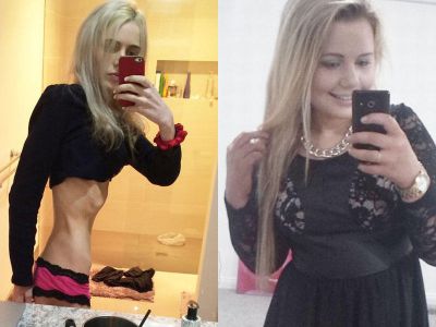 1 həftə yemək yemədi, bu hala düşdü