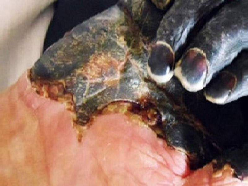 Şərqdə yeni qorxulu xəstəlik yayılır