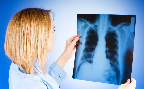 Son 25 il ərzində vərəmdən ölüm halları iki dəfə azalıb