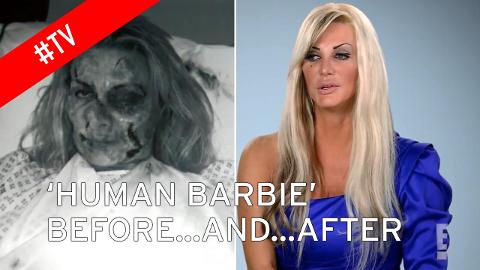 3 milyon dollar, 100 estetik əməliyyat... - “Barbie” olmaq istədi