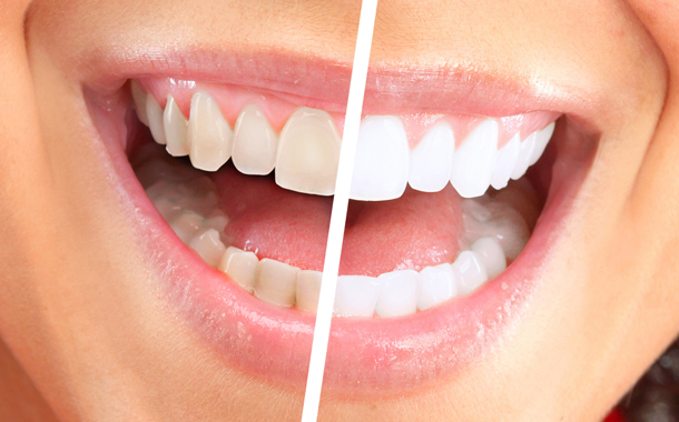 Dişlərinizi ağappaq etmək hələ belə asan olmamışdı