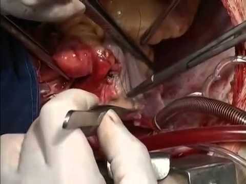 Cərrahlar ürəyin transplantasiya anlarını kameraya çəkiblər