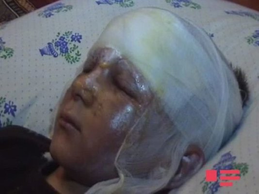 Tərtərdə partlayış: 8 yaşlı uşaq xəsarət alıb