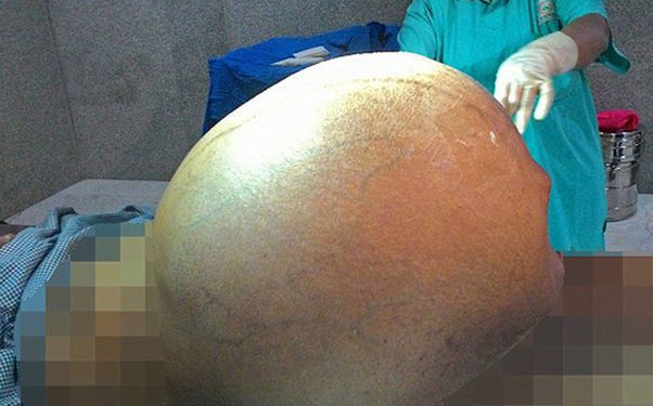 Hindistanda qadının qarnından fil balası ağırlığında şiş götürülüb