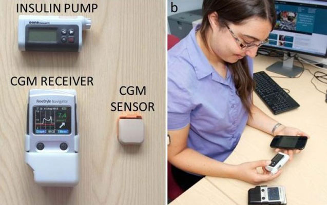 Smartfonla işləyən ilk süni mədəaltı vəz