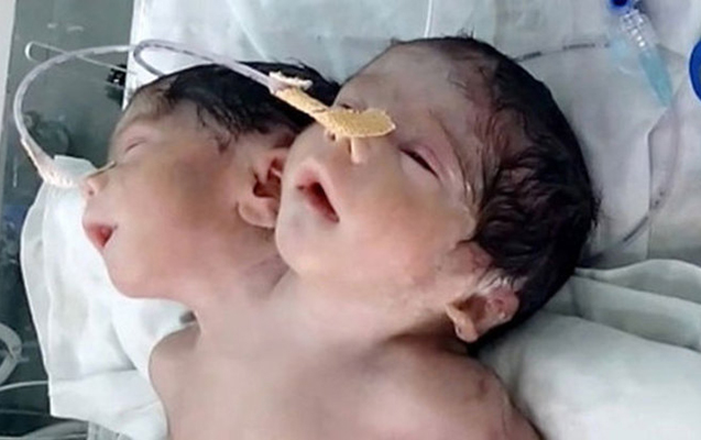 Hindistanda iki başlı körpə doğuldu