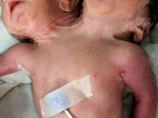 İkibaşlı uşaq doğuldu - VİDEO