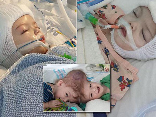 Başları bitişik əkizləri ayırdılar - Həkimlər yaşamayacaqlarını demişdilər...