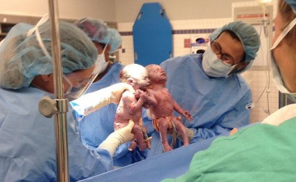Dünyaya gələn əkizlərin hərəkəti həkimləri ağlatdı - Fotolar