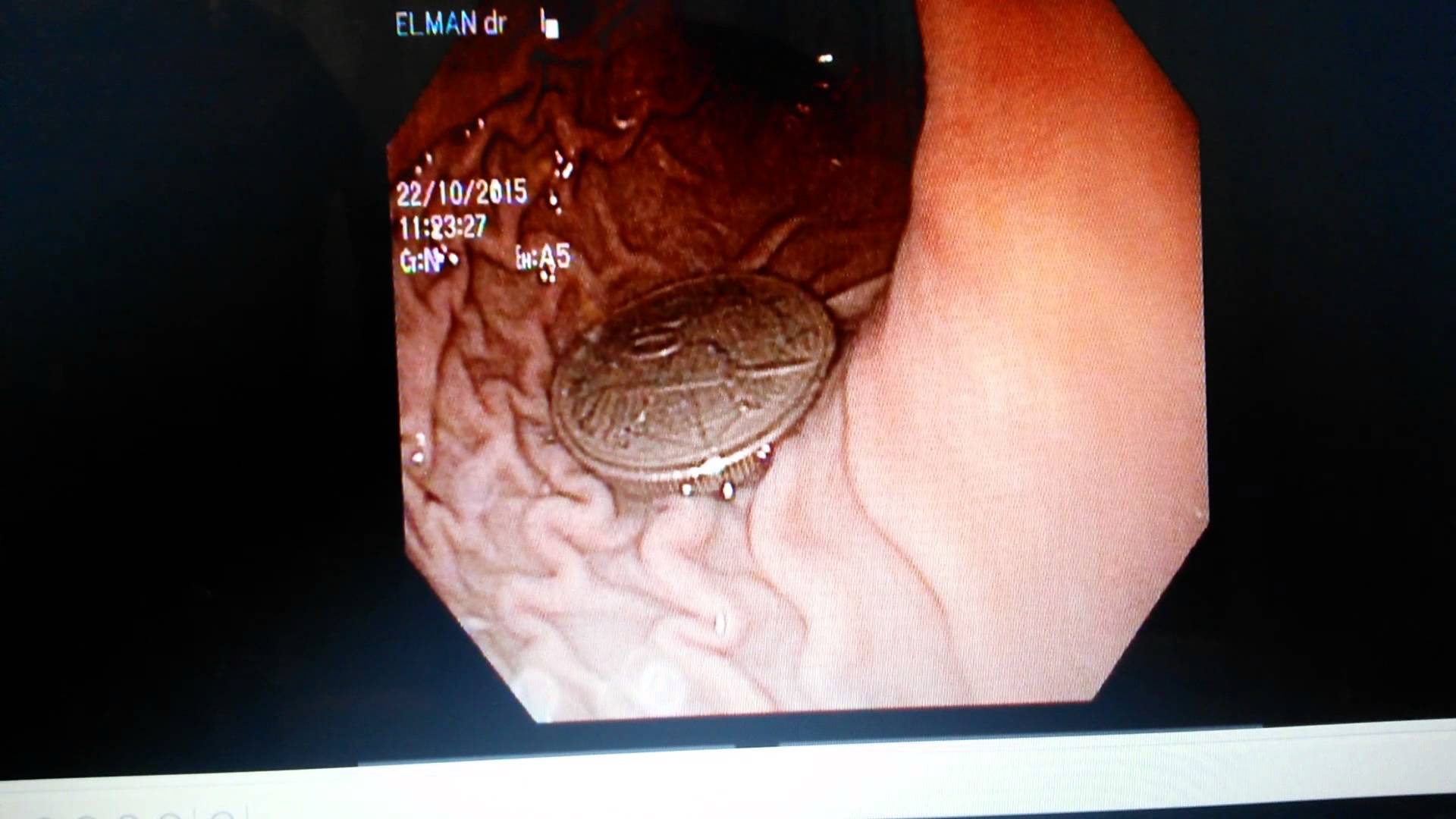 4 yaşlı uşağın mədəsindən `qəpik` çıxdı