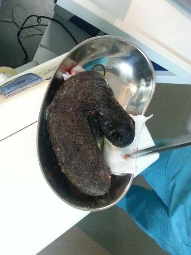 Qızın mədəsindən çıxanlar həkimləri HEYRƏTLƏNDİRDİ - BAKIDA - FOTO