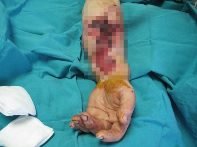 Salyanda DƏHŞƏT! 58 yaşlı kişinin qolu belэ qopdu