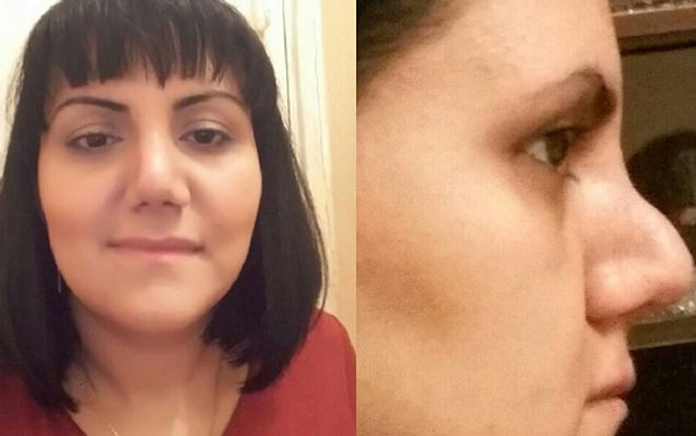 AVRASİYA HOSPİTALINDA BİABIRÇILIQ: Qadın burnunu əməliyyat elətdirdi, bu günə düşdü - ŞOK FOTO