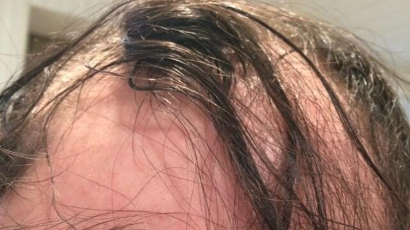 Saçınız tökülürsə, deməli bu xəstəliyiniz var – MÜTLƏQ OXUYUN!