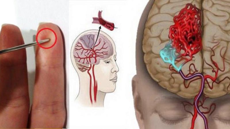 Adi iynə insult keçirən xəstənin həyatını xilas etdi - VİDEO