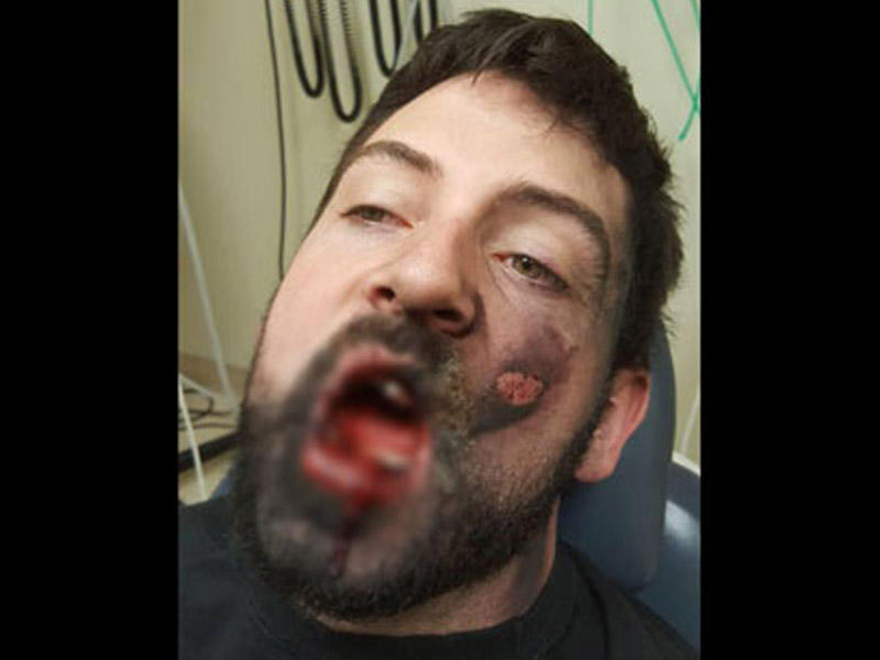 Eektron siqaret damağında partladı: 7 dişi töküldü - FOTOLAR