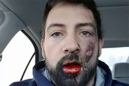 Elektron siqaret ağzında partladı, 7 dişini itirdi