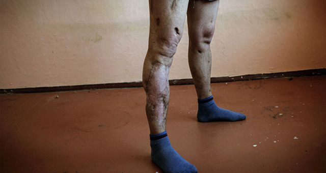 QORXUNC: Bu maddə çürüdür: Zombiyə çevrilən insan 2 ildə ölür - VİDEO