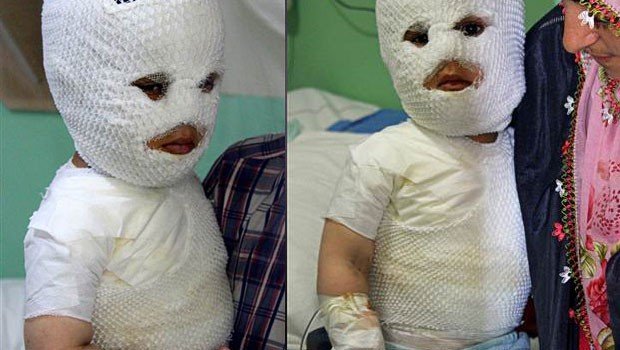 Salyanda qaynar suda yanan 1 yaşlı uşağın Bakıda FACİƏVİ SONU