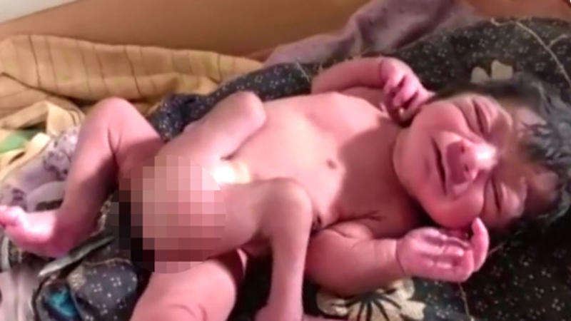 Dördayaqlı körpə doğuldu – FOTOLAR