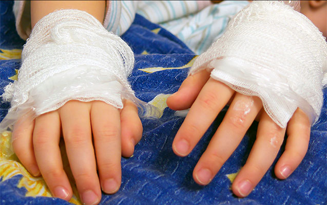 3 yaşlı qız süd qazanına düşərək yanıb