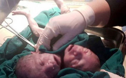 İki başlı uşaq dünyaya gəldi - Əkiz deyillər - FOTOLAR