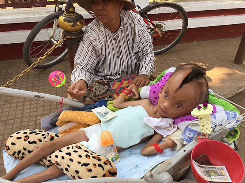 Zavallı uşaq: başındakı dəlik fasiləsiz böyüyür - VİDEO - FOTO