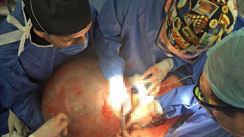 Qadının qarnından çıxanlar tibb dünyasını şoka saldı - FOTOLAR