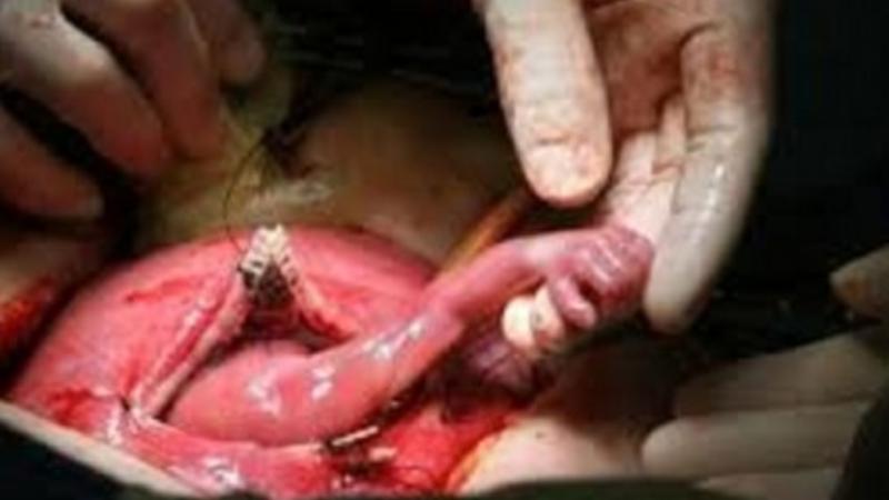 Ürəyi zəif olanlar baxmasın! - Abort olunan döl həkimin əlindən tutdu - DƏHŞƏTLİ VİDEO