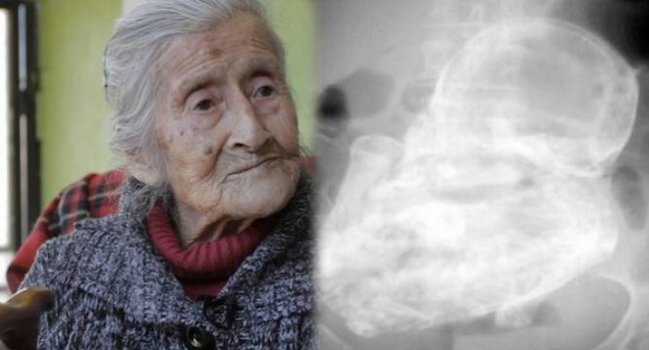 60 ildir hamilə imiş - Tibb dünyası ŞOKDA