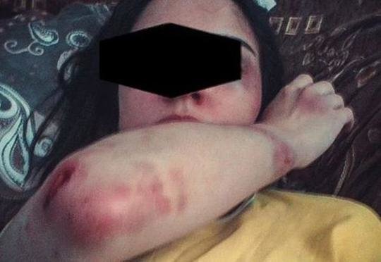 Azərbaycanda DƏHŞƏT: Ər hamilə arvadını ütü ilə yandırıb zorladı