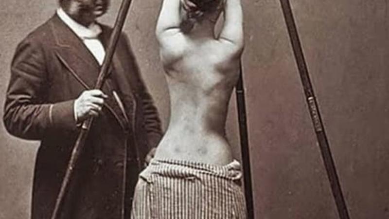 Ötən əsrin QORXUNC TİBB ÜSULLARI - FOTOLAR