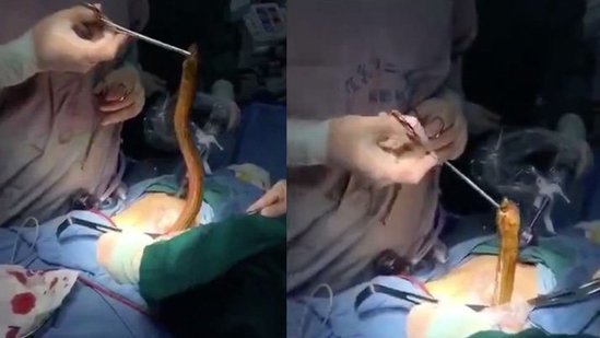 DÜNYA ŞOKDA! Mədəsindən İLAN ÇIXDI