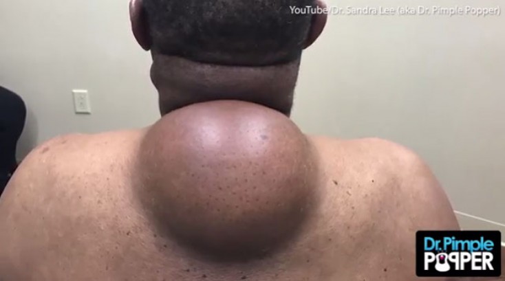 Əməliyyat zamanı şişin içindən görün nə çıxdı... - Çox baxmayın, ürəyiniz bulanacaq! / FOTOLAR