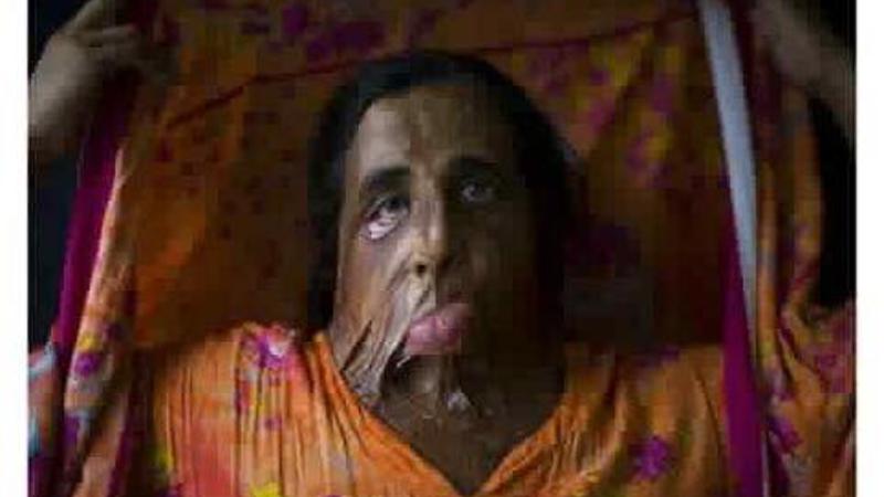 Ərinin cinsi istəyinə yox dedi, üzünü kislota ilə yandırdılar