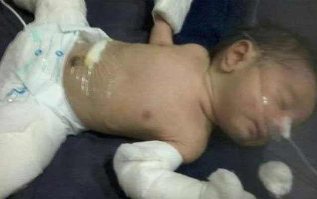 Ana bətnində uşaq əkiz tayını udub