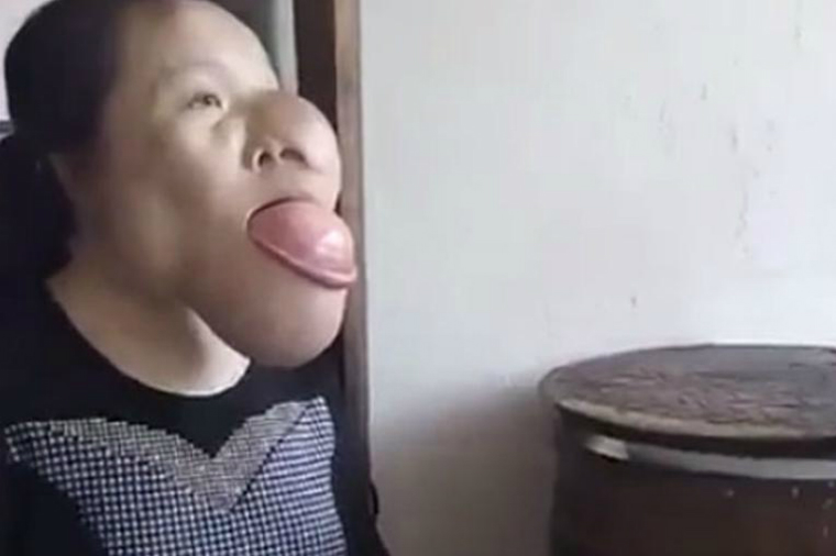 Uşaq vaxtı yoluxduğu xəstəlik onu bu hala saldı — VİDEO