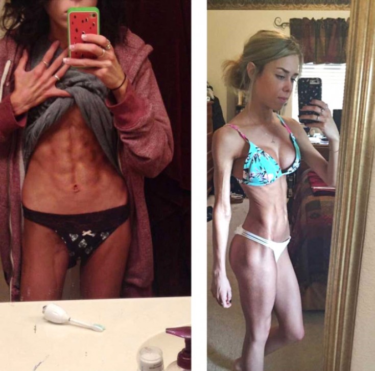 Xəstəlikdən sağalan gənc qız hamını kövrəltdi - FOTOLAR