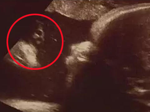 Hamilə qadın müayinə zamanı qorxuya düşdü: bətnində qəribə varlıq göründü - FOTO