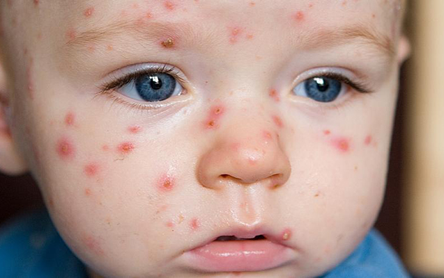 Suçiçəyi ilə bağlı ölüm halı olmayıb - Açıqlama