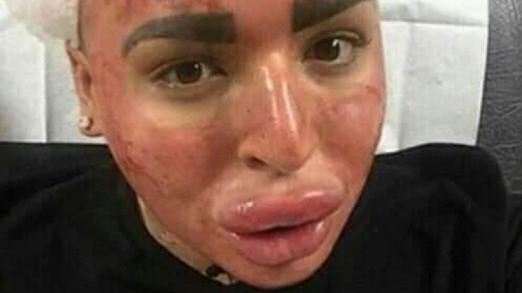 Bakıda estetik əməliyyat etdirən qız bu hala düşdü - FOTO