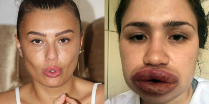 Azərbaycanda təhsil alan estetik cərrah qızın dodaqlarına qapı-pəncərə silikonu vurdu (FOTO)