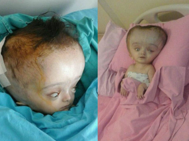 Azərbaycanda 3 yaşlı qız xəstəlikdən bu hala düşdü - FOTO