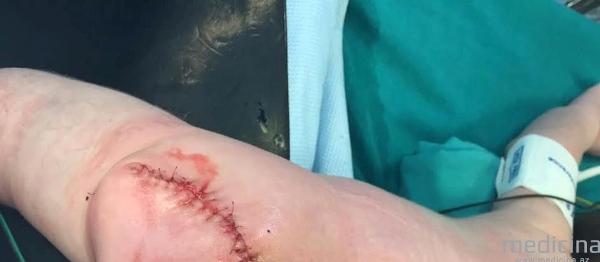 Uşaq 5 kiloqramlıq şişlə doğuldu - Azərbaycanda qəribə tibbi anomaliya/ FOTOLAR