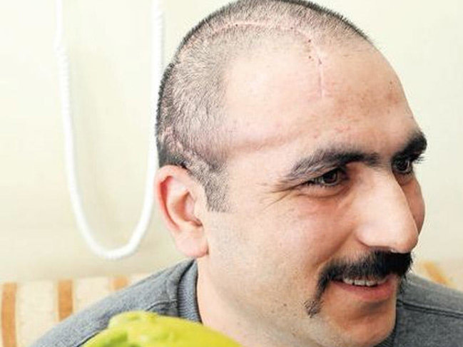 Aprel döyüşündə yaralanan hərbçiyə süni baş qapağı qoyuldu - FOTO