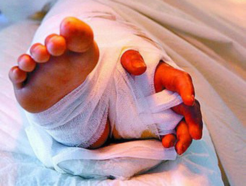 Fantastik əməliyyat! Uşağın kəsilmiş əlini görün harasına tikdilər - FOTO