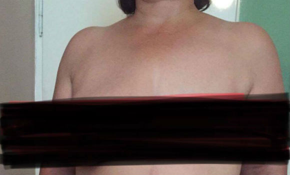 Azərbaycanda təksinəli xanım uğurlu əməliyyatdan sonra cütsinəli oldu — FOTOLAR