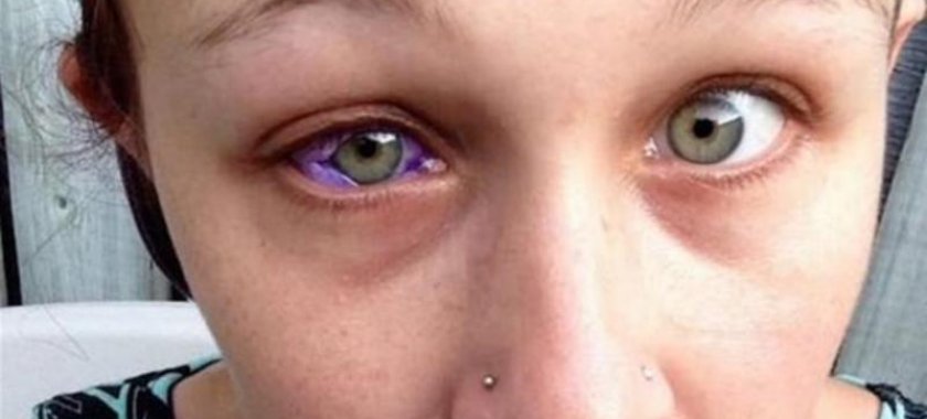 Gözünün rəngini dəyişmək istədi - Bəlaya düçar oldu - FOTOLAR